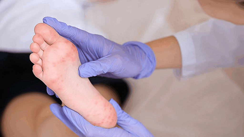 Measles Outbreak on Utah-Arizona Border